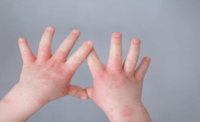 Do You Have an Eczema: Discover Its Causes and Symptoms Screenshot 64