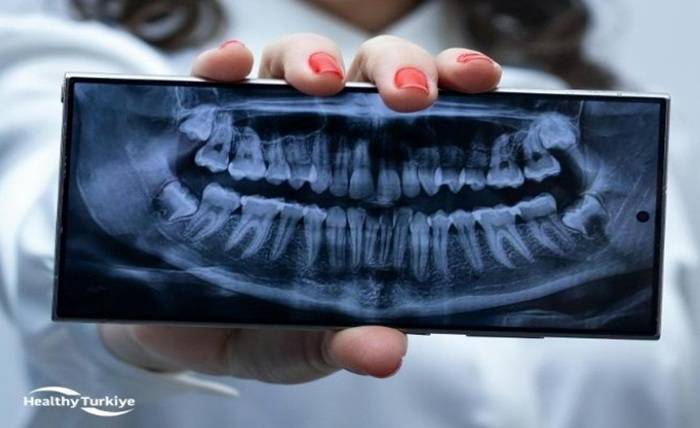 What to Expect After All-on-6 Dental Implant Surgery in Turkey Screenshot 12 2